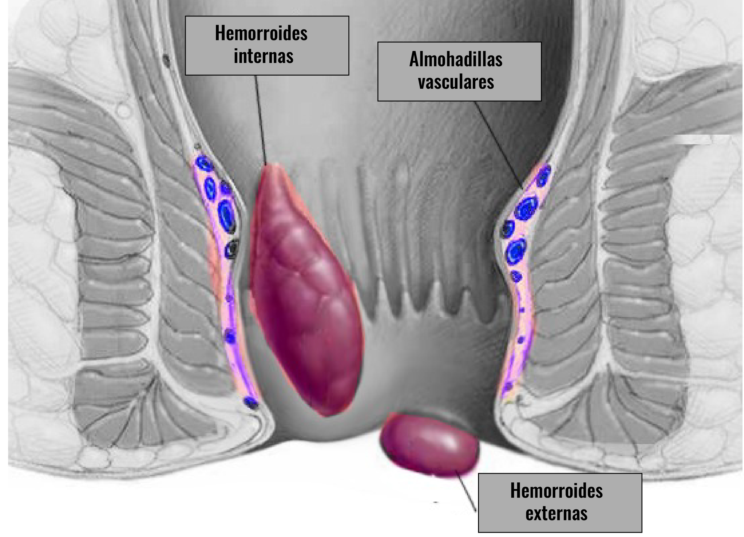 Identifica las señales de la enfermedad hemorroidal