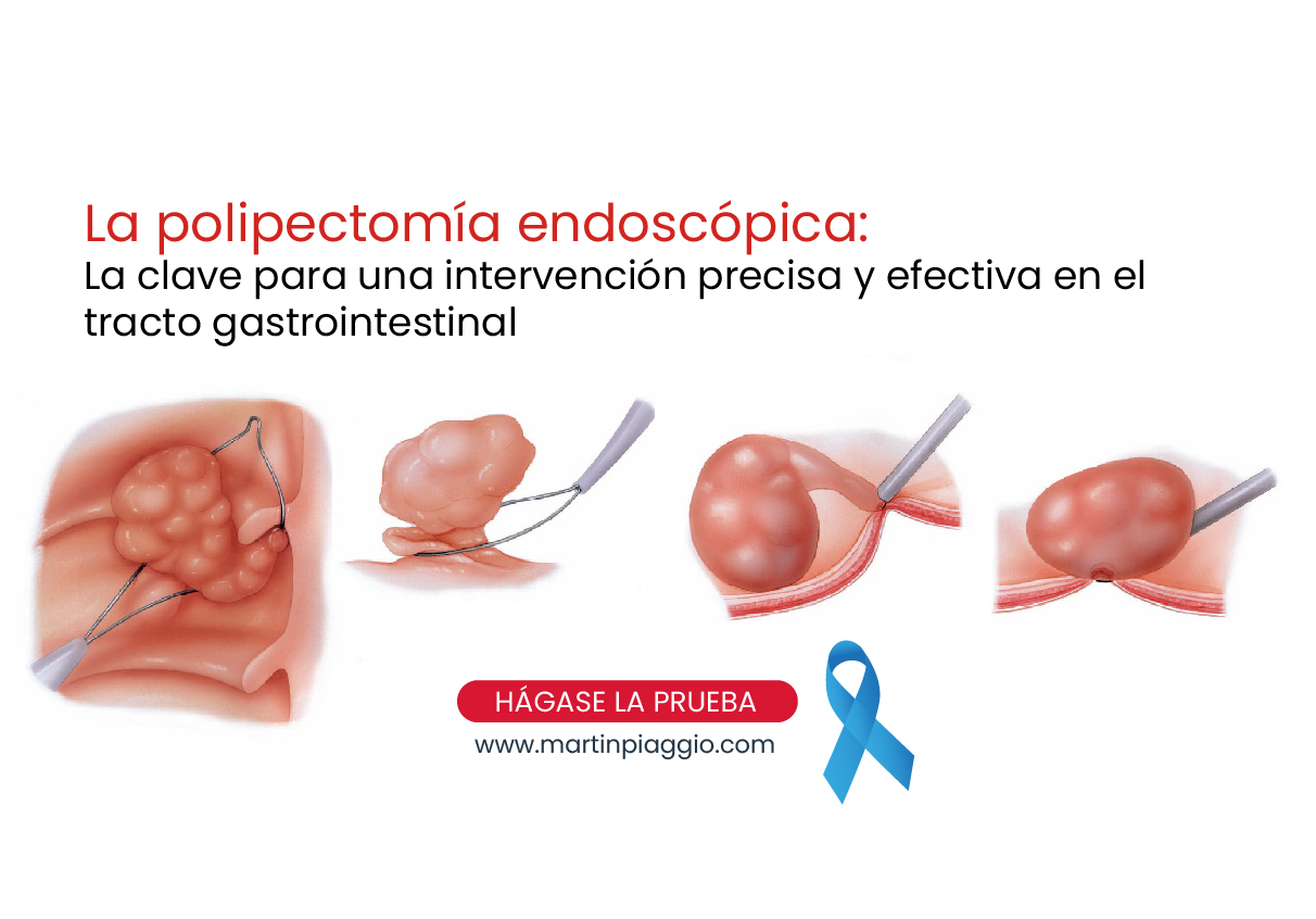 Abordando el Síndrome del Colon Irritable