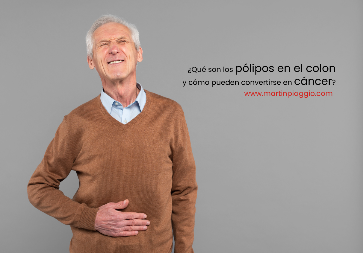 ¿Qué son los pólipos en el colon y cómo pueden convertirse en cáncer? 